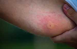 Insect Bites